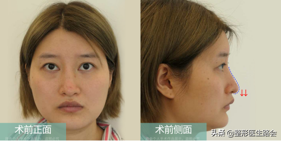 隆鼻手术全过程「真实细节」分享,想要做鼻子的姑娘一定要看看 图片-10