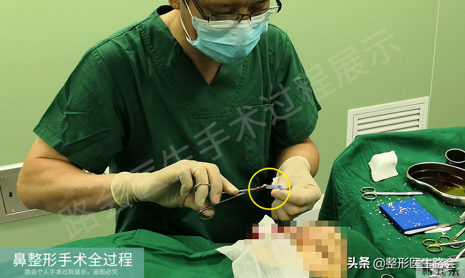 隆鼻手术全过程「真实细节」分享,想要做鼻子的姑娘一定要看看 图片-18