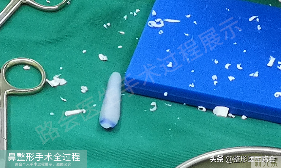 隆鼻手术全过程「真实细节」分享,想要做鼻子的姑娘一定要看看 图片-19