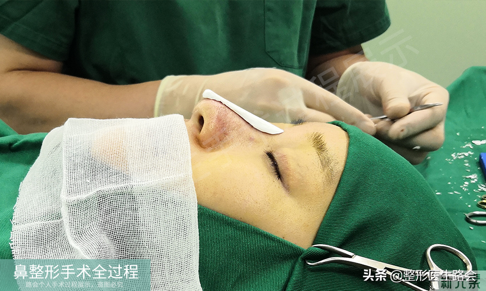隆鼻手术全过程「真实细节」分享,想要做鼻子的姑娘一定要看看 图片-23