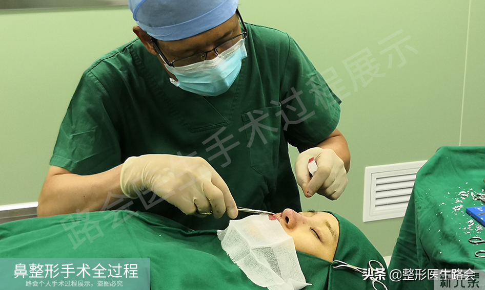 隆鼻手术全过程「真实细节」分享,想要做鼻子的姑娘一定要看看 图片-26
