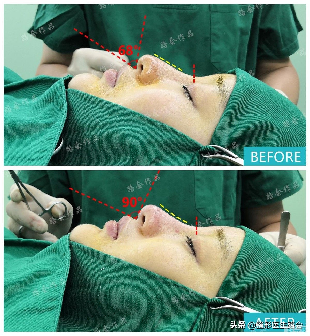 隆鼻手术全过程「真实细节」分享,想要做鼻子的姑娘一定要看看 图片-27