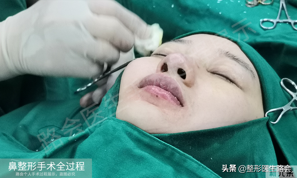 隆鼻手术全过程「真实细节」分享,想要做鼻子的姑娘一定要看看 图片-28