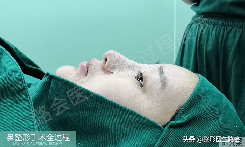 隆鼻手术全过程「真实细节」分享,想要做鼻子的姑娘一定要看看 图片-30