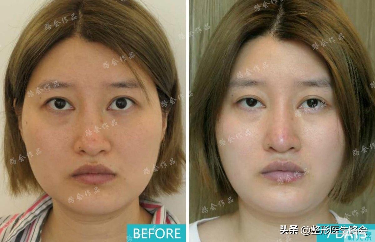 隆鼻手术全过程「真实细节」分享,想要做鼻子的姑娘一定要看看 图片-31