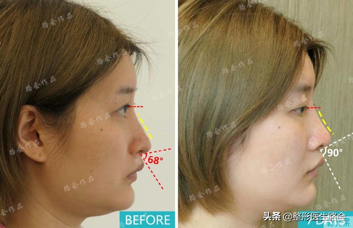 隆鼻手术全过程「真实细节」分享,想要做鼻子的姑娘一定要看看 图片-32