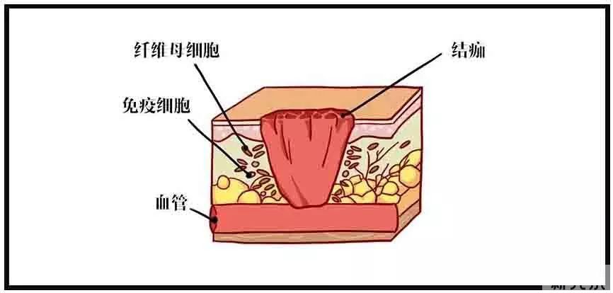疤痕修护的黄金时期,千万别错过 图片-2