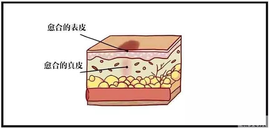 疤痕修护的黄金时期,千万别错过 图片-5
