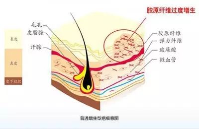 疤痕修护的黄金时期,千万别错过 图片-4