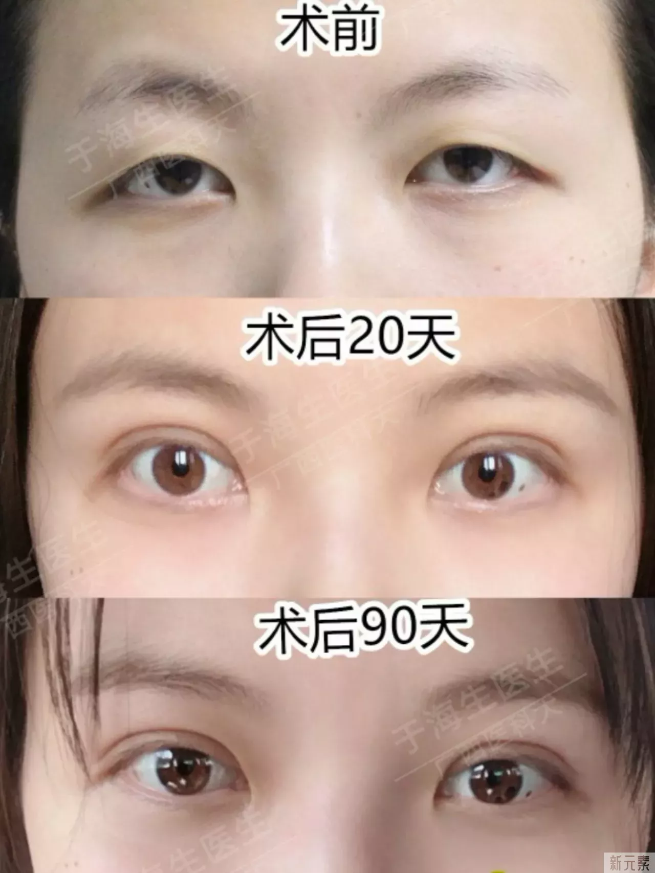 这位姑娘初眼为单眼皮,眼睛形状并不好看, 图片-1
