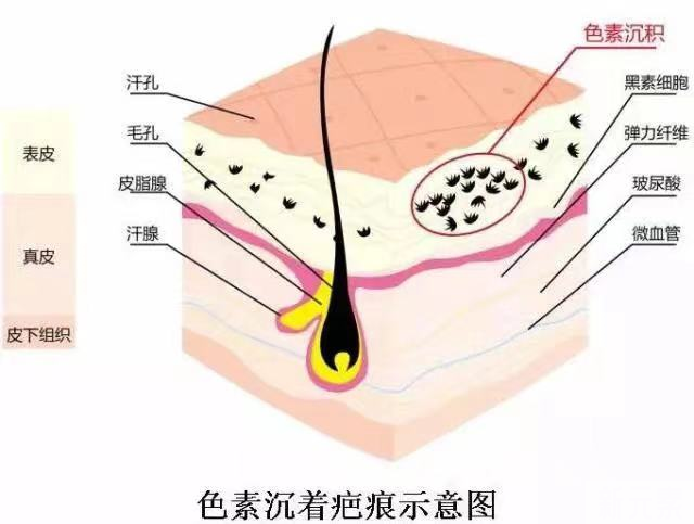 皮肤受损后,出现色素沉着应该这样做! 图片-4
