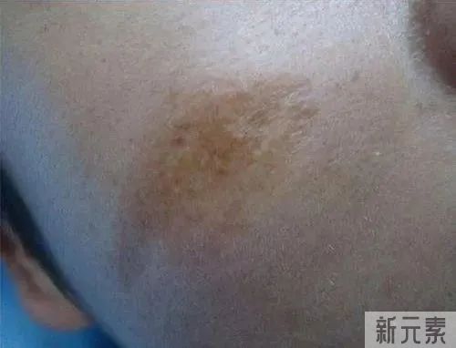 皮肤受损后,出现色素沉着应该这样做! 图片-6
