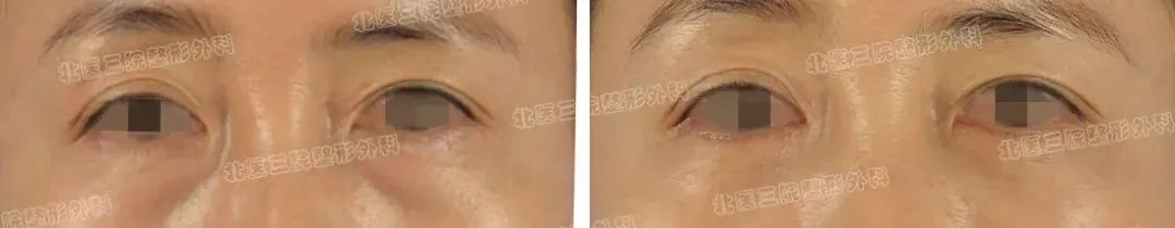 切眼袋+眶隔脂肪释放 一次手术解决两个问题 图片-1
