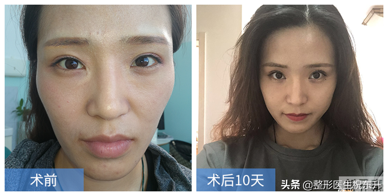做了面部脂肪填充3个月后，我的脸变成了什么样? 图片-2