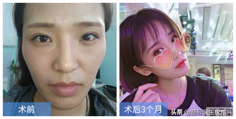 做了面部脂肪填充3个月后，我的脸变成了什么样? 图片-3