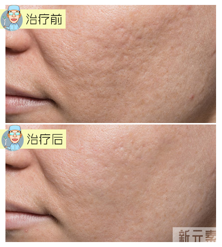 缩毛孔的正确打开方式 图片-9