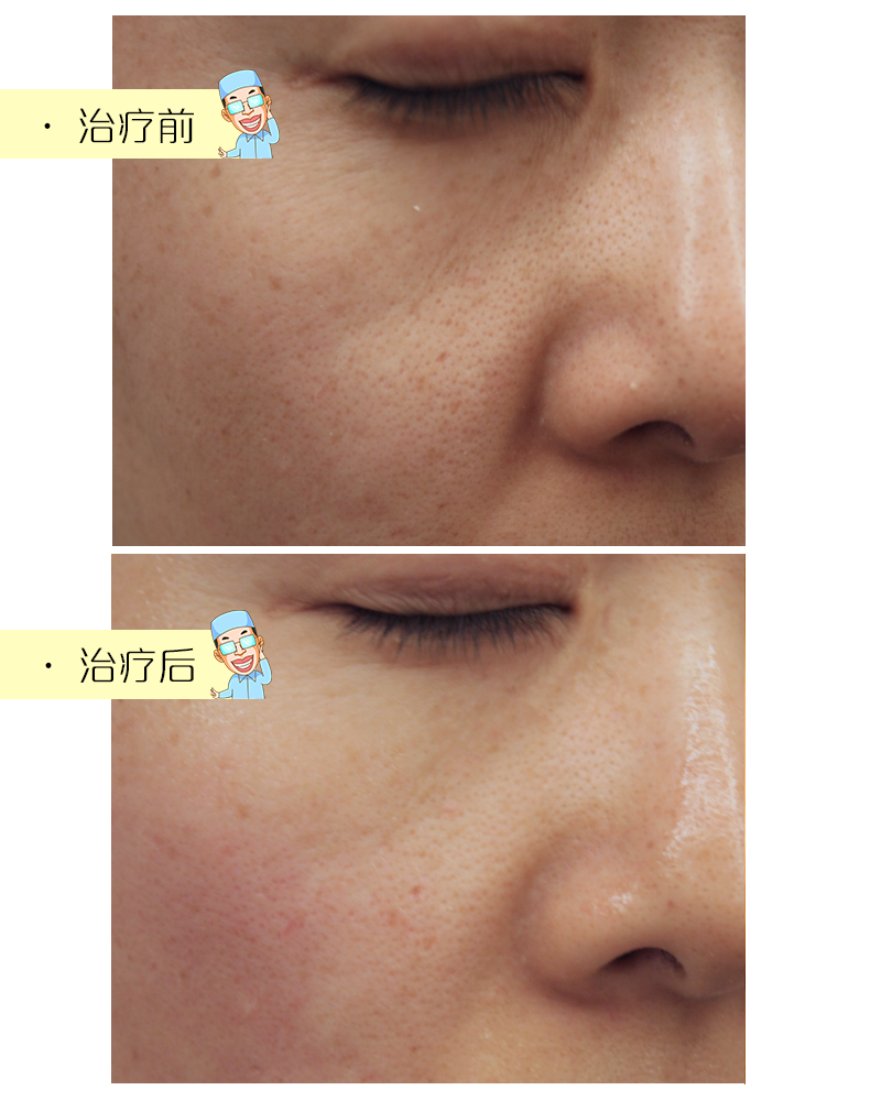 缩毛孔的正确打开方式 图片-10