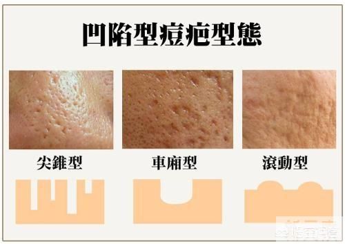 脸上的痘坑有什么方法可以消除? 图片-1