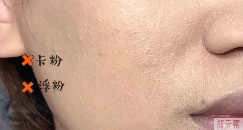 一到春天就毛孔粗大，该怎么办? 图片-3