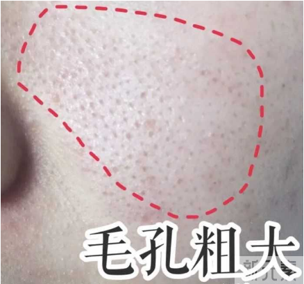 一到春天就毛孔粗大，该怎么办? 图片-4