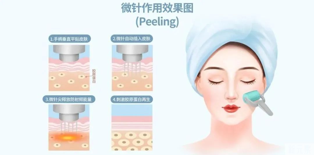 一到春天就毛孔粗大，该怎么办? 图片-9