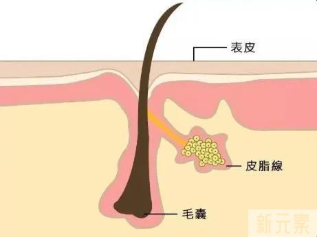 一到春天就毛孔粗大，该怎么办? 图片-5