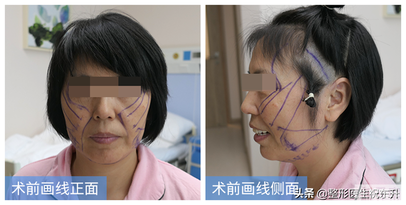 做了拉皮手术，场面血淋淋、疼得哇哇叫?你想多了 图片-1
