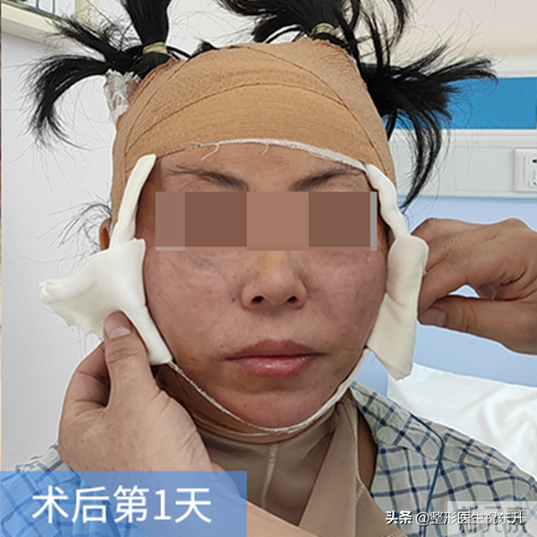 做了拉皮手术，场面血淋淋、疼得哇哇叫?你想多了 图片-3