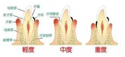 牙龈萎缩不可逆，提前预防可远离! 图片-4
