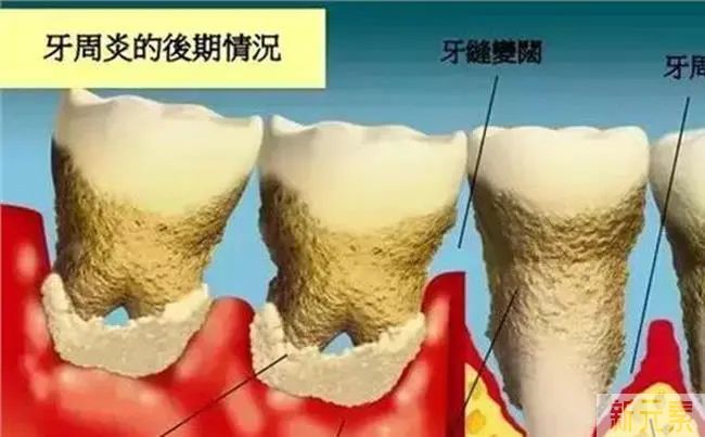 牙龈萎缩不可逆，提前预防可远离! 图片-6
