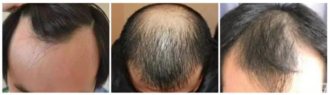 后枕部毛囊的特别之处，您知多少? 图片-3