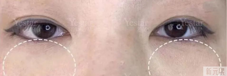 日本整骨大师徒手消除眼袋?实测7天后我悟了... 图片-11