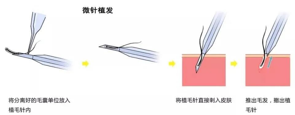 植发手术为什么会失败?90%的原因是...... 图片-6