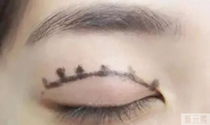 都是割双眼皮，为什么你的看起来假? 图片-1