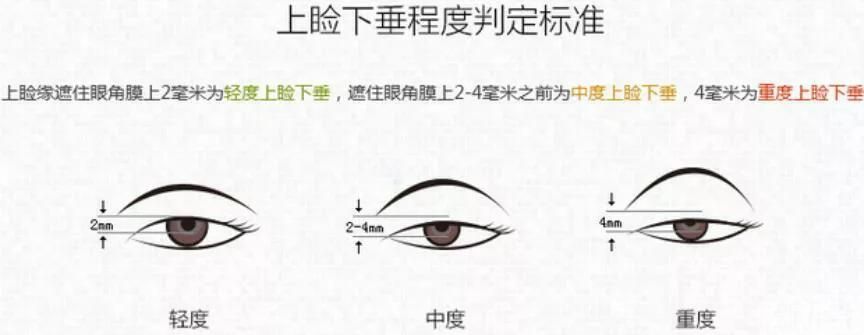 都是割双眼皮，为什么你的看起来假? 图片-4