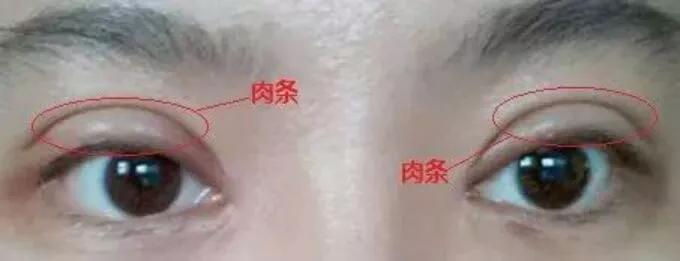 都是割双眼皮，为什么你的看起来假? 图片-3
