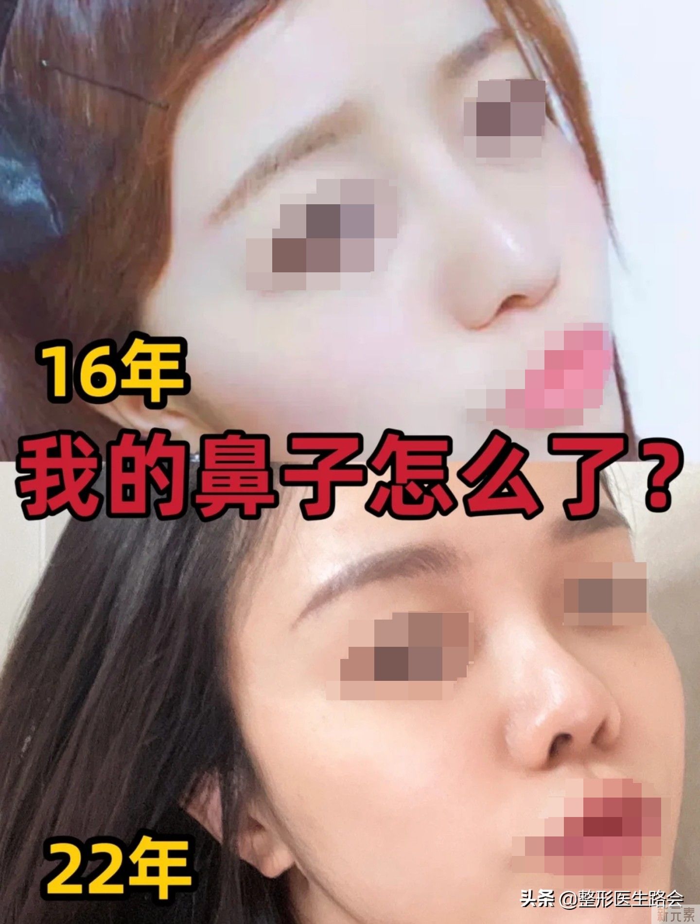 一个“硅胶鼻”多久可以稳定，不“挛缩”了 图片-1