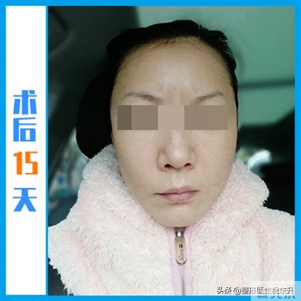 小拉皮术后73天，反馈来了!这或许才是“中老年少女”的真相 图片-3