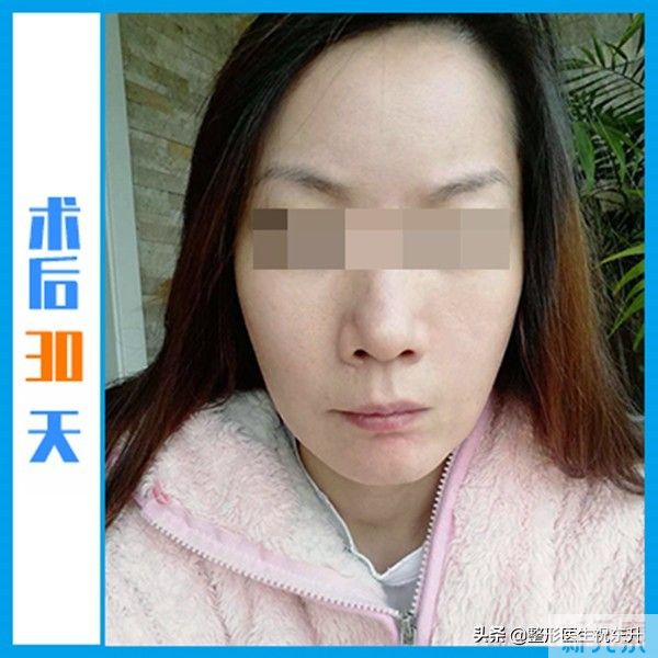 小拉皮术后73天，反馈来了!这或许才是“中老年少女”的真相 图片-4