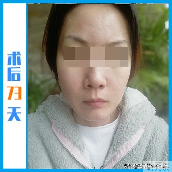小拉皮术后73天，反馈来了!这或许才是“中老年少女”的真相 图片-5