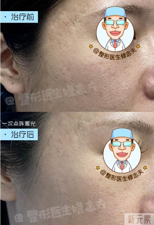 毛孔粗怎么解决? 图片-2