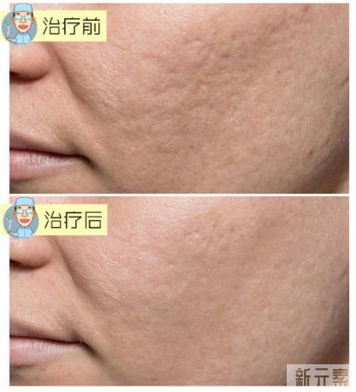 毛孔粗怎么解决? 图片-4