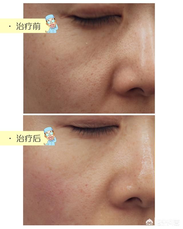 毛孔粗怎么解决? 图片-5