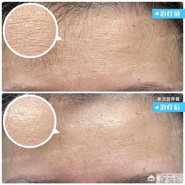 毛孔粗怎么解决? 图片-7