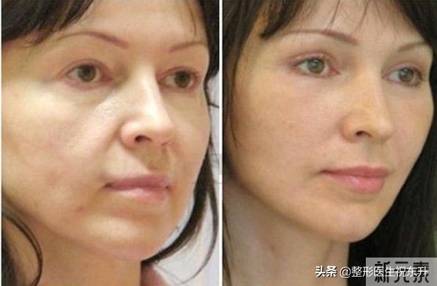 做了自体脂肪填充面部，这结果挺出乎意料的 图片-1