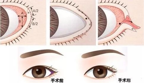 为什么内眼角可以做，外眼角不建议随便做? 图片-7