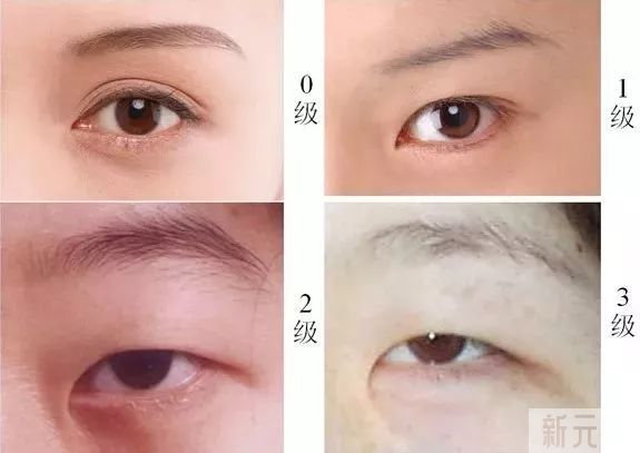 为什么内眼角可以做，外眼角不建议随便做? 图片-4