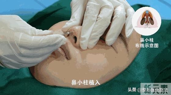 做鼻整形我只有两点要求:必须创伤小，必须能蹦极 图片-2