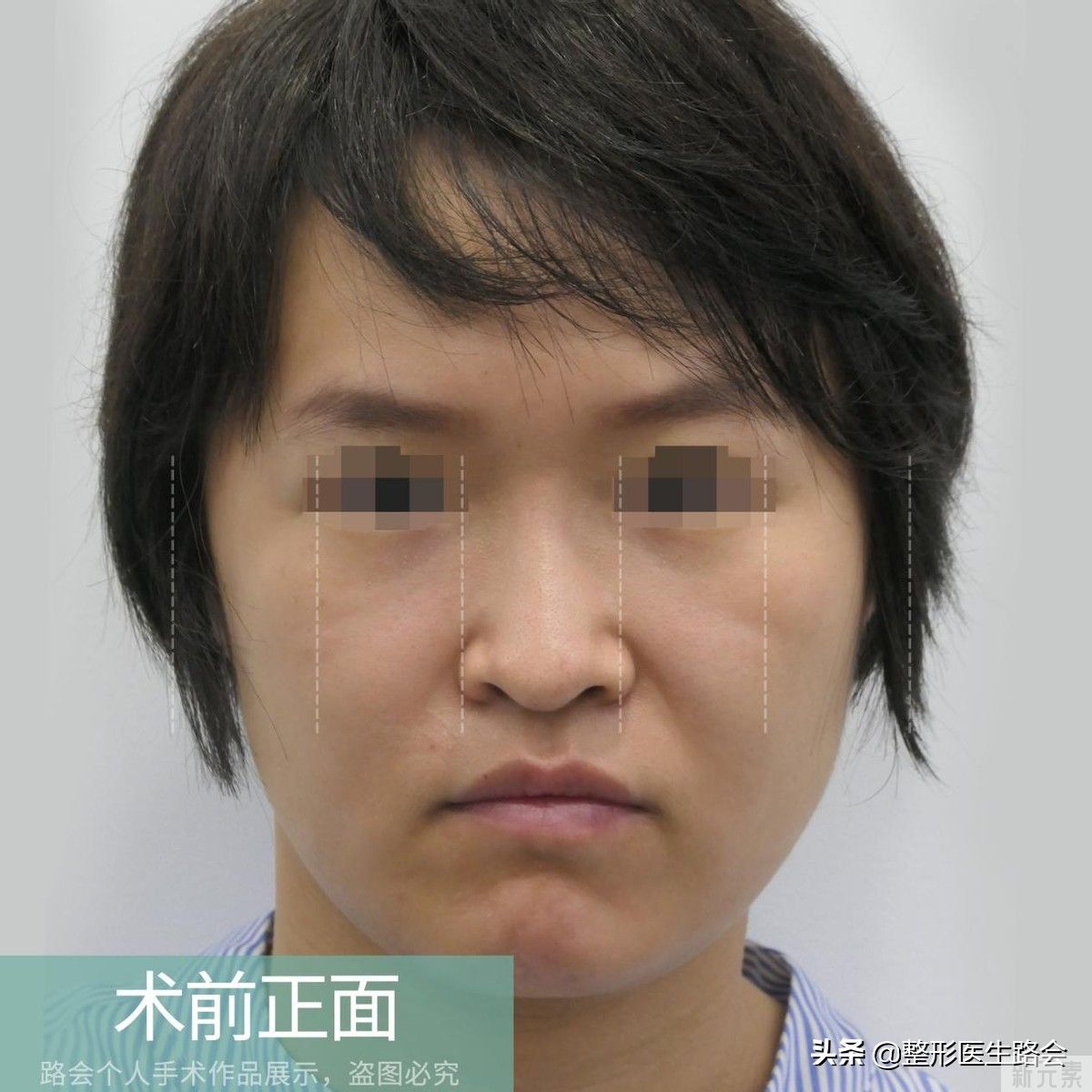做鼻整形我只有两点要求:必须创伤小，必须能蹦极 图片-6