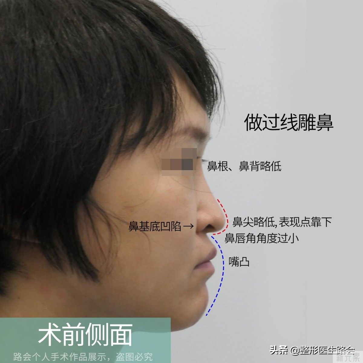 做鼻整形我只有两点要求:必须创伤小，必须能蹦极 图片-7